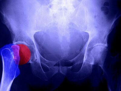 Ensure Proper Bone GrowthwithGrowth Hormones